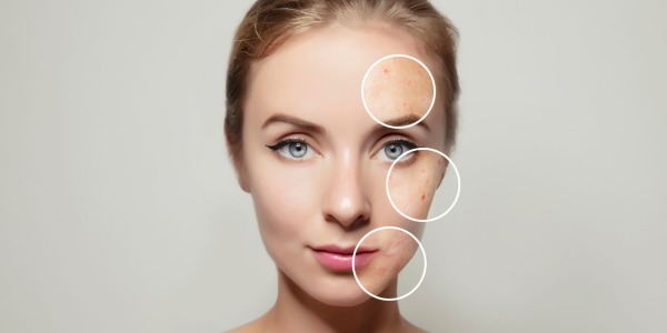 Pelle grassa del viso: cause e come trattarla con rimedi efficaci e delicati